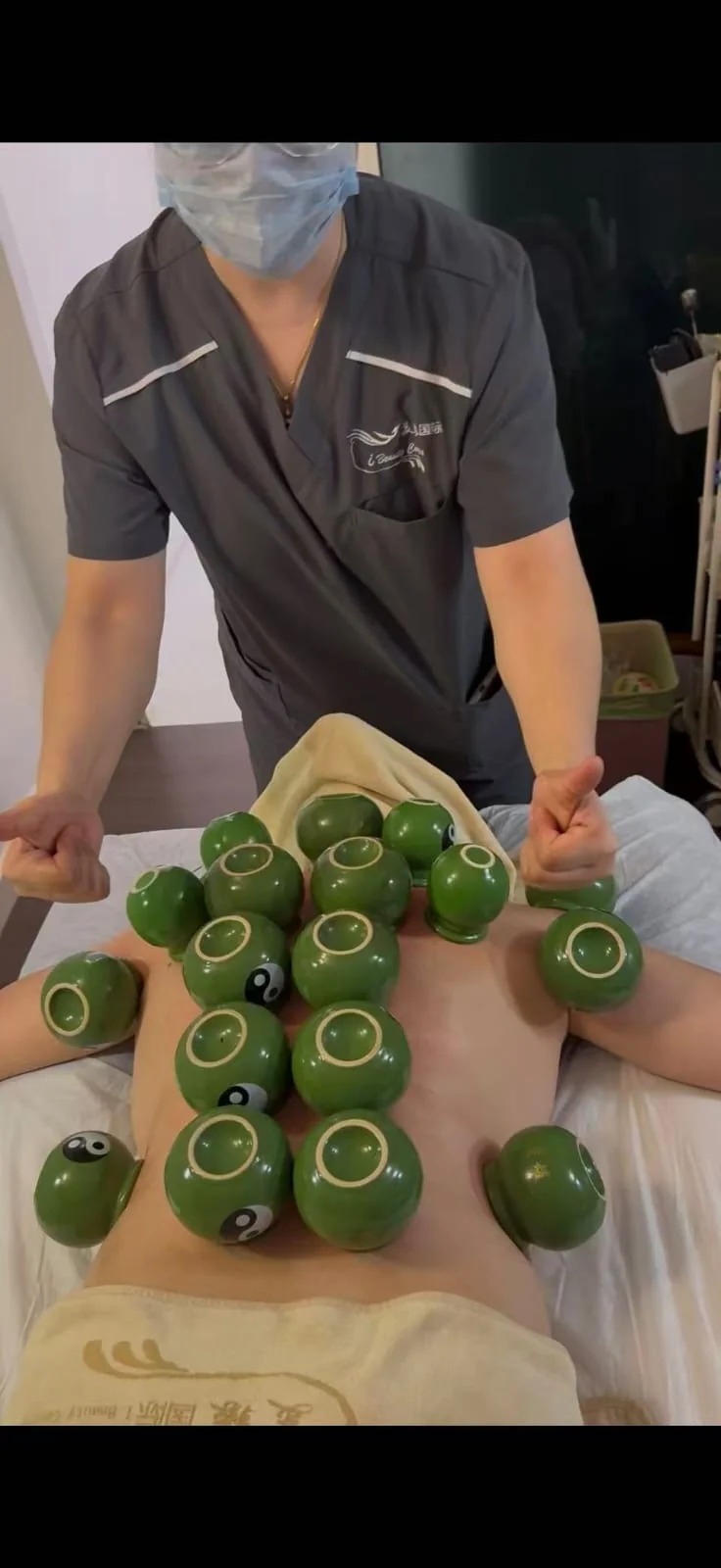 Actual body cupping treatment at iBeauty Centre
