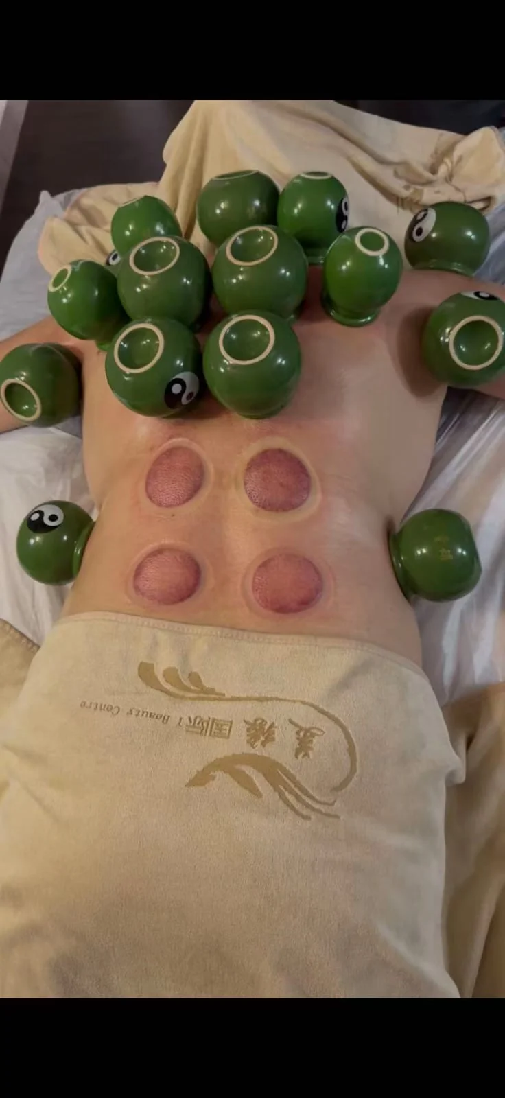Cupping treatment using green cups at iBeauty Centre